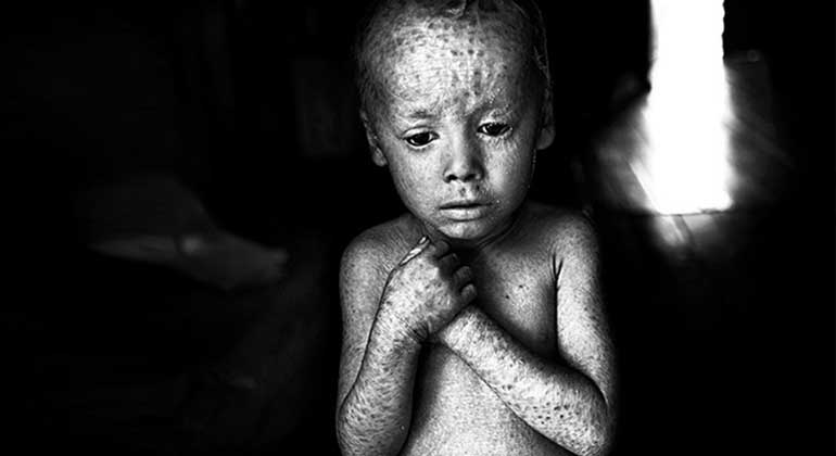 Kehrer Verlag | Piovano - 2/07/2014 - Colonia Alicia, Misiones province. Lucas Techeira is five years old and was born with an incurable disease called ichthyosis lamellar, caused by a gene mutation. His parents worked in a tobacco field and other plantations in the area where agrochemicals such as glyphosate and 2,4-D, one of the components of Agent Orange, are sprayed.